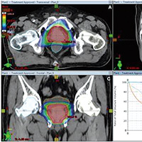 NRG Oncology RTOG 0415持久分析 大分割放疗依旧非劣效于常规分割放疗 
